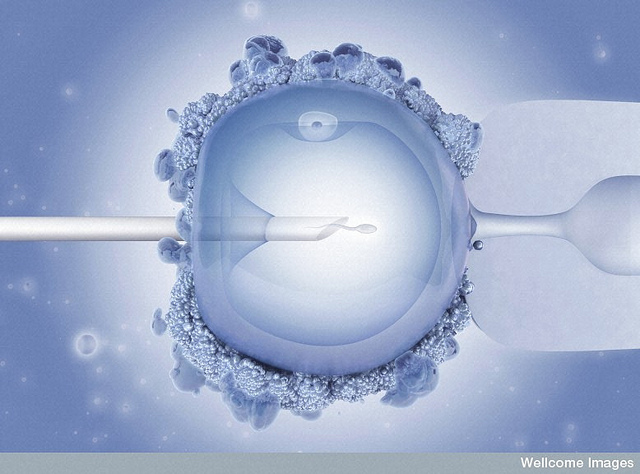 ИКСИ оплождане - Инжектиране на сперматозоид в цитоплазмата